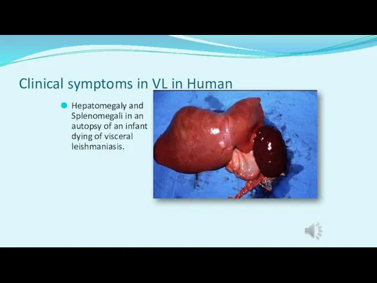 Clinical symptoms in VL in Human Hepatomegaly and Splenomegali in an autopsy