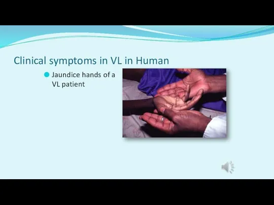 Clinical symptoms in VL in Human Jaundice hands of a VL patient