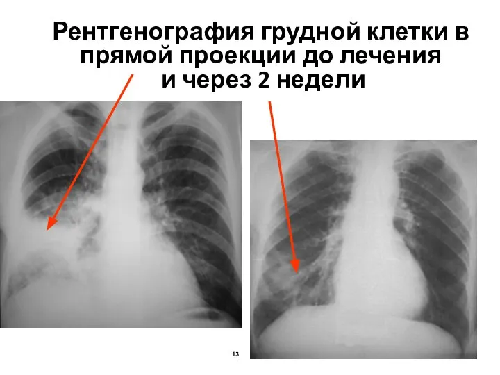 Рентгенография грудной клетки в прямой проекции до лечения и через 2 недели