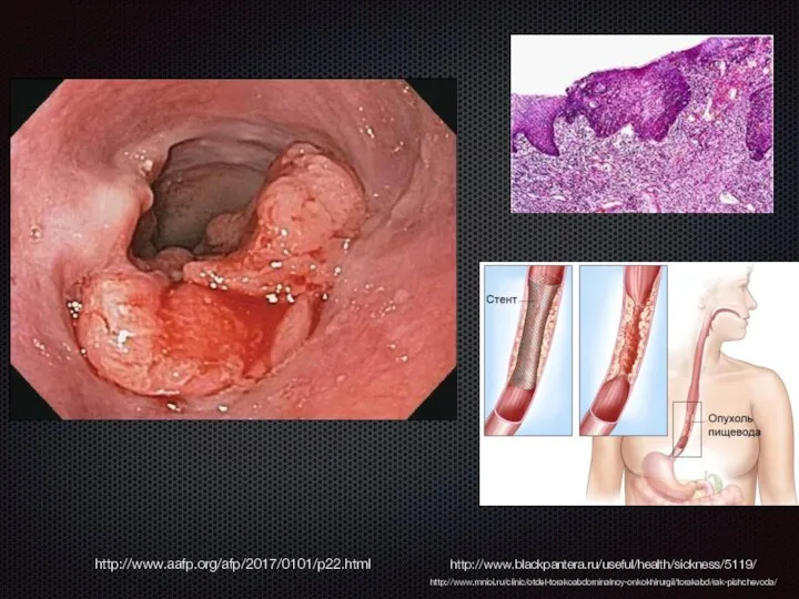 http://www.aafp.org/afp/2017/0101/p22.html http://www.blackpantera.ru/useful/health/sickness/5119/ http://www.mnioi.ru/clinic/otdel-torakoabdominalnoy-onkokhirurgii/torakabd/rak-pishchevoda/