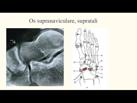 Os supranaviculare, supratali