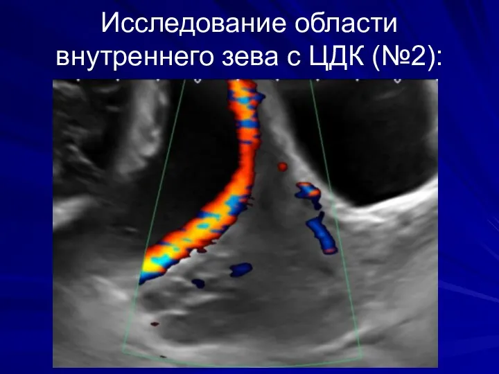 Исследование области внутреннего зева с ЦДК (№2):