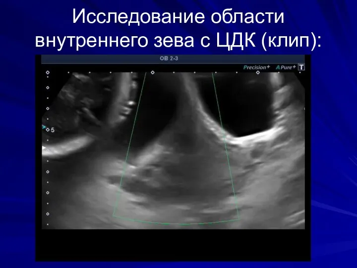 Исследование области внутреннего зева с ЦДК (клип):