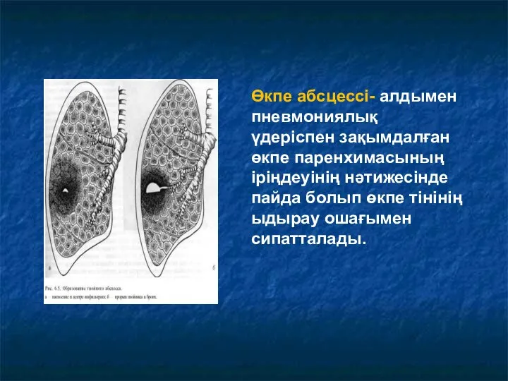 Өкпе абсцессі- алдымен пневмониялық үдеріспен зақымдалған өкпе паренхимасының іріңдеуінің нәтижесінде пайда болып