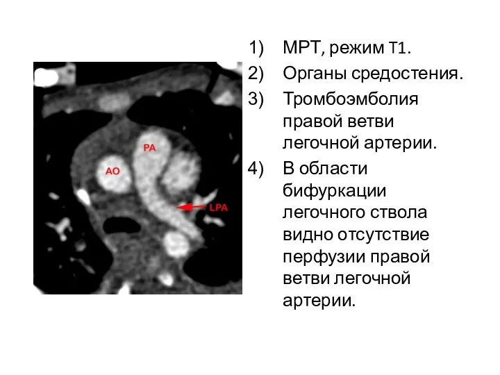 МРТ, режим T1. Органы средостения. Тромбоэмболия правой ветви легочной артерии. В области