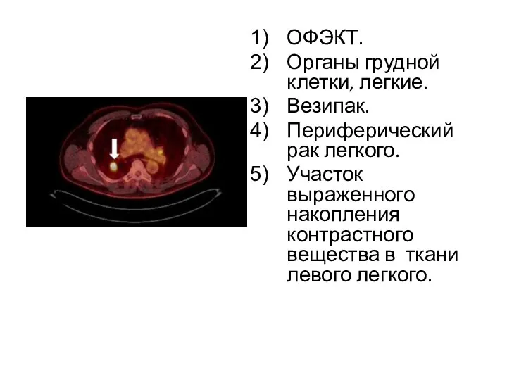 ОФЭКТ. Органы грудной клетки, легкие. Везипак. Периферический рак легкого. Участок выраженного накопления