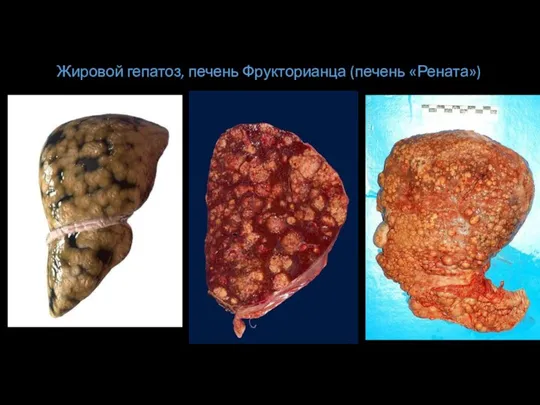 Жировой гепатоз, печень Фрукторианца (печень «Рената»)