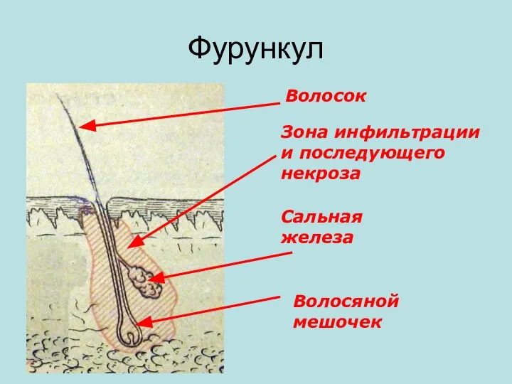 Фурункул Волосяной мешочек Сальная железа Зона инфильтрации и последующего некроза Волосок