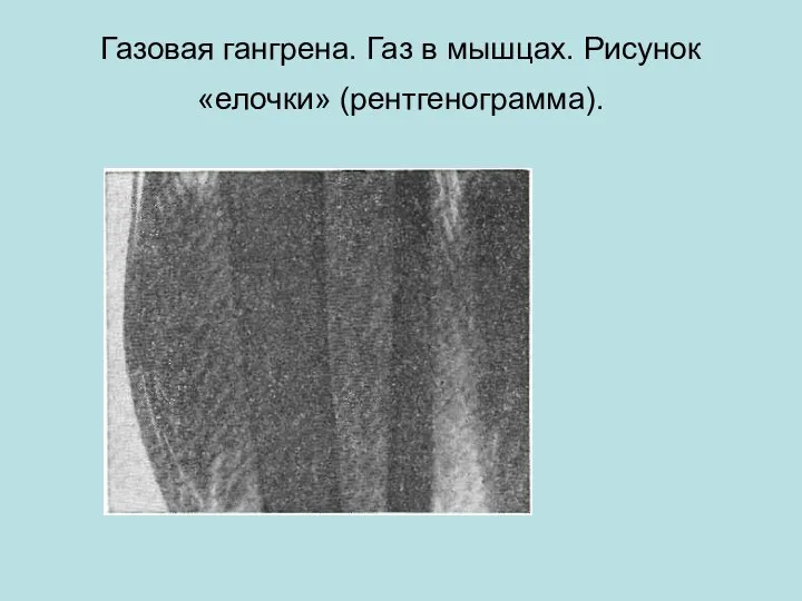 Газовая гангрена. Газ в мышцах. Рисунок «елочки» (рентгенограмма).