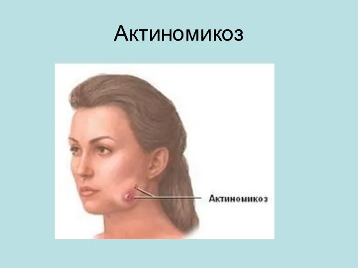 Актиномикоз