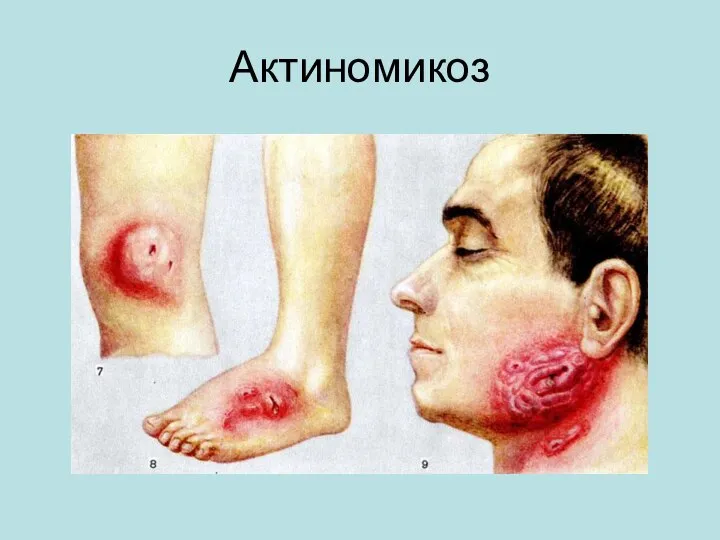 Актиномикоз