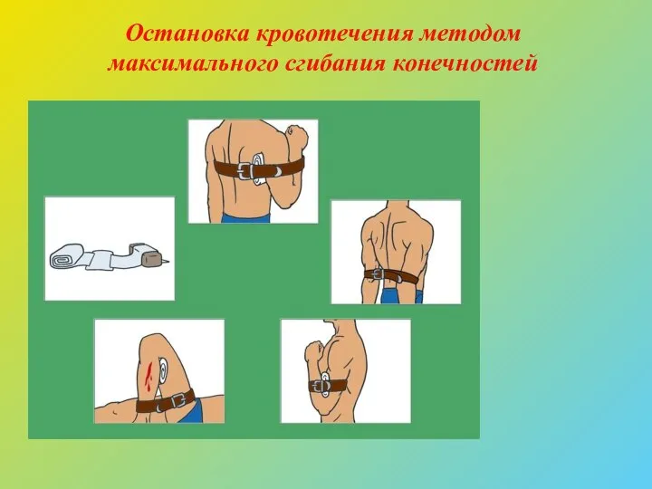 Остановка кровотечения методом максимального сгибания конечностей