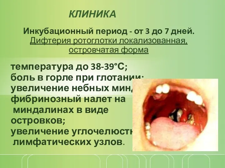 Инкубационный период - от 3 до 7 дней. Дифтерия ротоглотки локализованная, островчатая