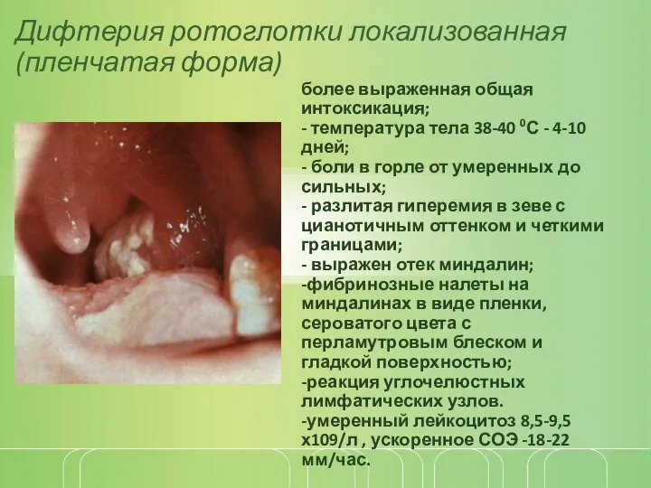 Дифтерия ротоглотки локализованная (пленчатая форма) более выраженная общая интоксикация; - температура тела