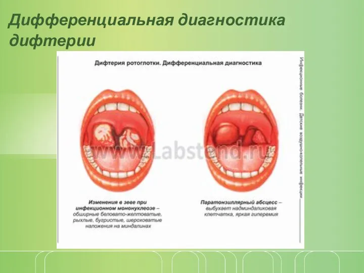 Дифференциальная диагностика дифтерии