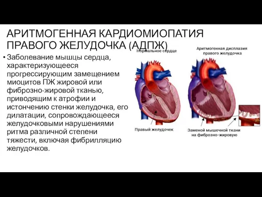 АРИТМОГЕННАЯ КАРДИОМИОПАТИЯ ПРАВОГО ЖЕЛУДОЧКА (АДПЖ) Заболевание мышцы сердца, характеризующееся прогрессирующим замещением миоцитов