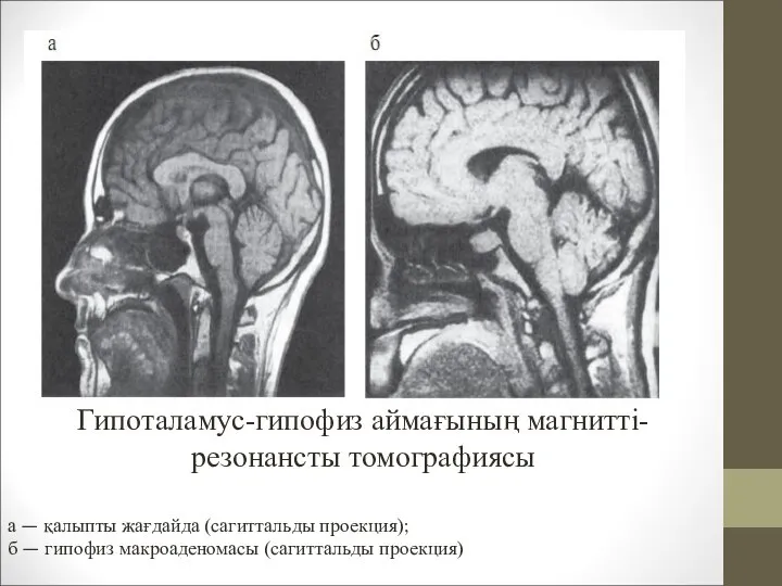 а — қалыпты жағдайда (сагиттальды проекция); б — гипофиз макроаденомасы (сагиттальды проекция) Гипоталамус-гипофиз аймағының магнитті-резонансты томографиясы