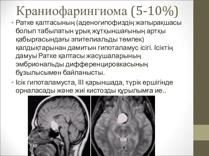 Краниофарингиома (5-10%) Ратке қалтасының (аденогипофиздің жапырақшасы болып табылатын ұрық жұтқыншағының артқы қабырғасындағы