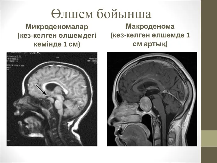 Өлшем бойынша Микроденомалар (кез-келген өлшемдегі кемінде 1 см) Макроденома (кез-келген өлшемде 1 см артық)