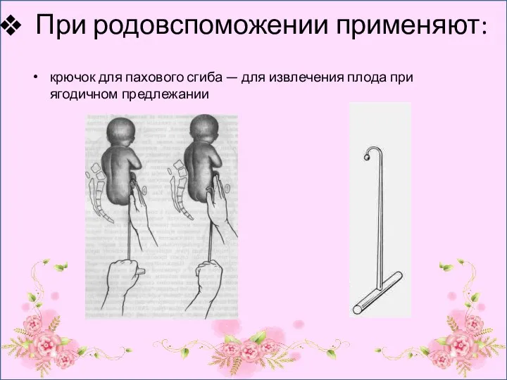 При родовспоможении применяют: крючок для пахового сгиба — для извлечения плода при ягодичном предлежании