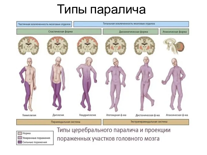 Типы паралича