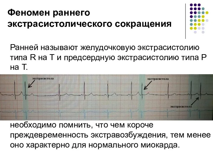 Феномен раннего экстрасистолического сокращения Ранней называют желудочковую экстрасистолию типа R на Т