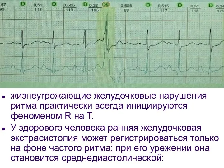 жизнеугрожающие желудочковые нарушения ритма практически всегда инициируются феноменом R на Т. У