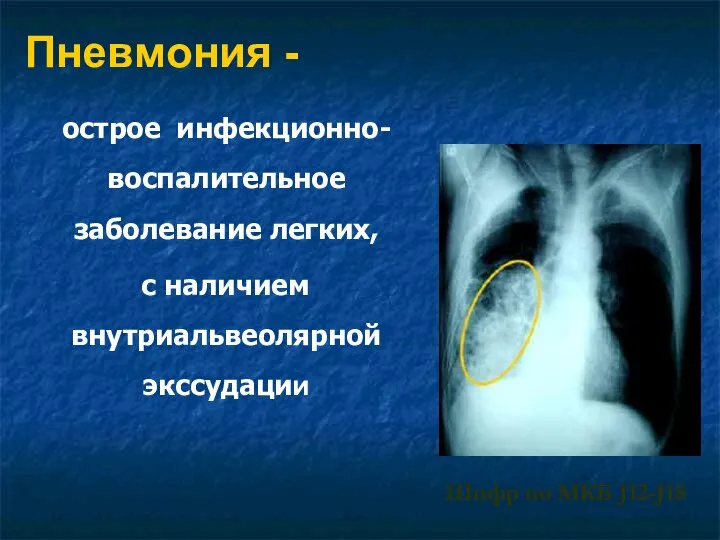 Пневмония - острое инфекционно-воспалительное заболевание легких, с наличием внутриальвеолярной экссудации Шифр по МКБ J12-J18