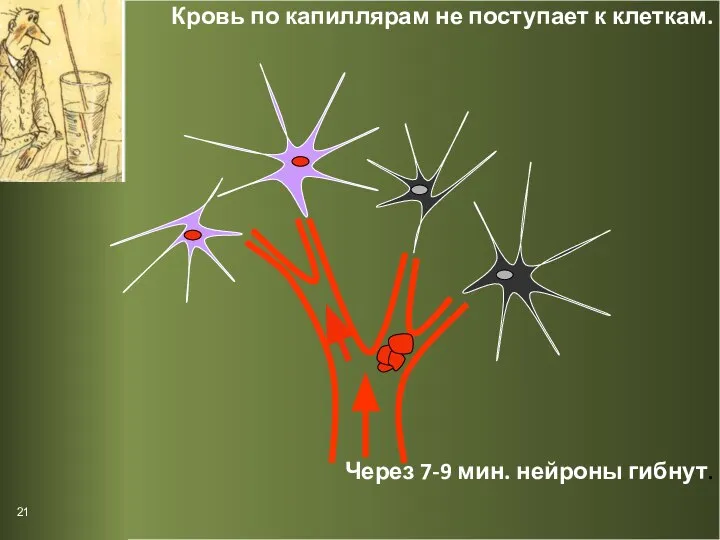 Кровь по капиллярам не поступает к клеткам. Через 7-9 мин. нейроны гибнут. 21