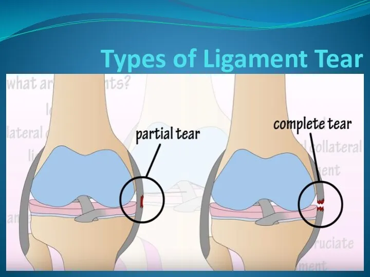 Types of Ligament Tear Ligament -noun Swelling - adjective Appointment - noun