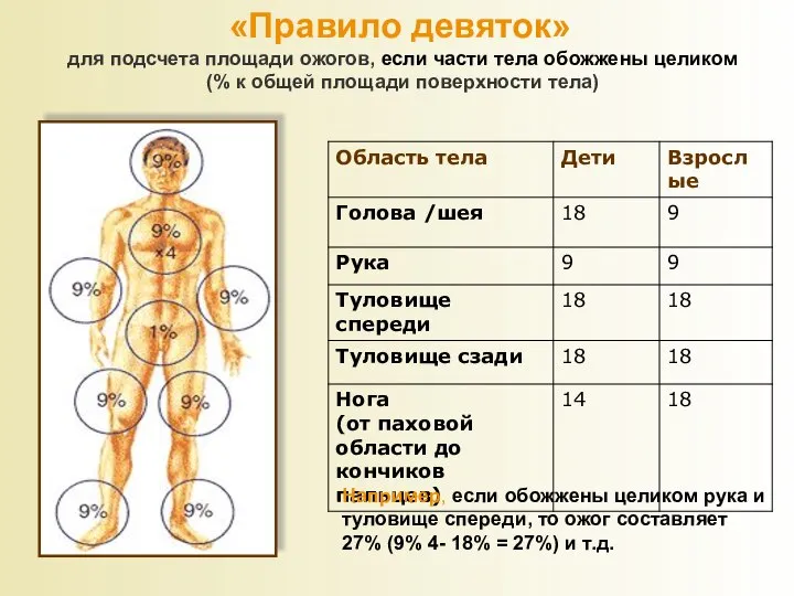 «Правило девяток» для подсчета площади ожогов, если части тела обожжены целиком (%