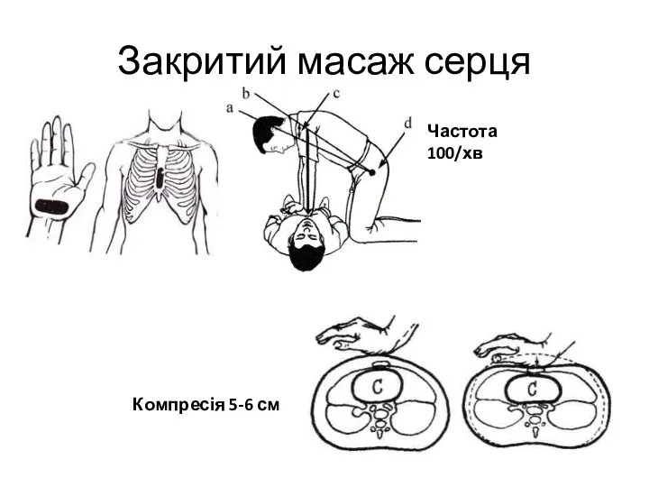 Закритий масаж серця Частота 100/хв Компресія 5-6 см