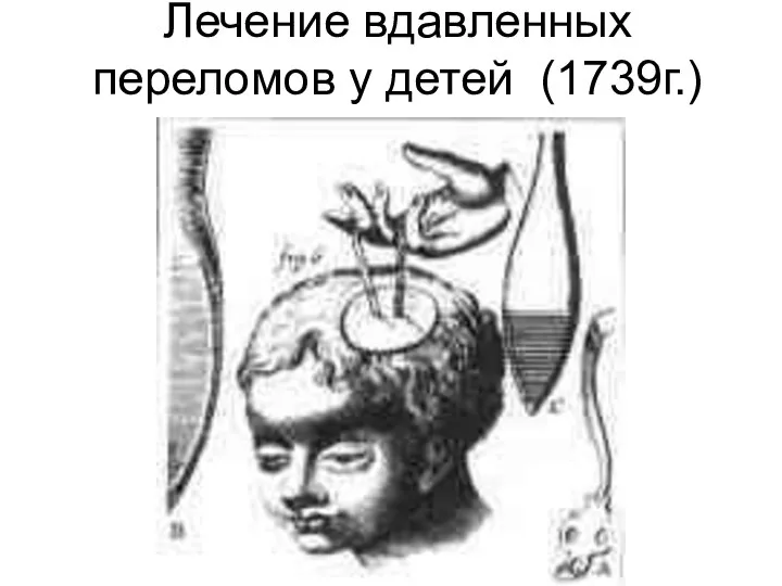 Лечение вдавленных переломов у детей (1739г.)