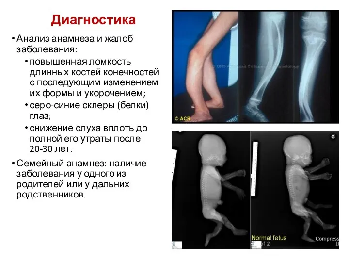 Диагностика Анализ анамнеза и жалоб заболевания: повышенная ломкость длинных костей конечностей с