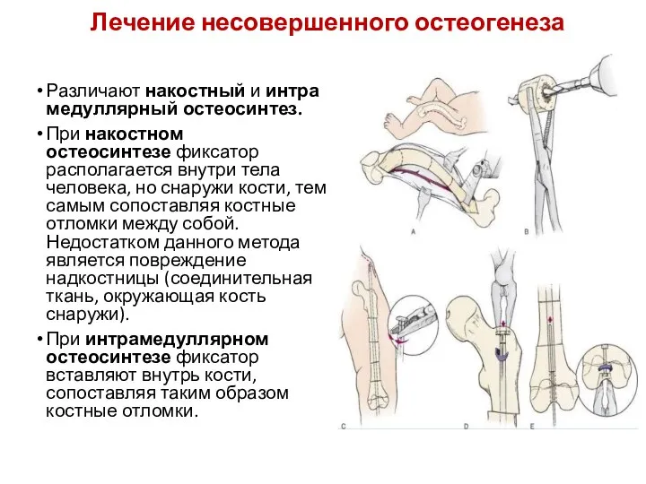 Лечение несовершенного остеогенеза Различают накостный и интрамедуллярный остеосинтез. При накостном остеосинтезе фиксатор