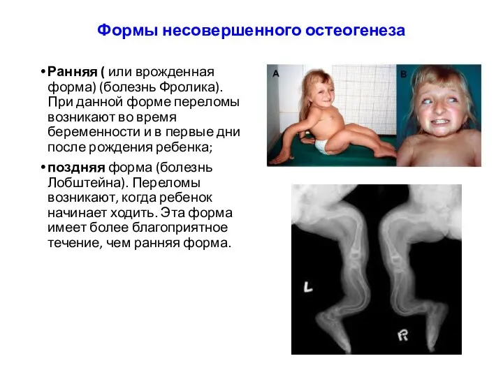 Формы несовершенного остеогенеза Ранняя ( или врожденная форма) (болезнь Фролика). При данной