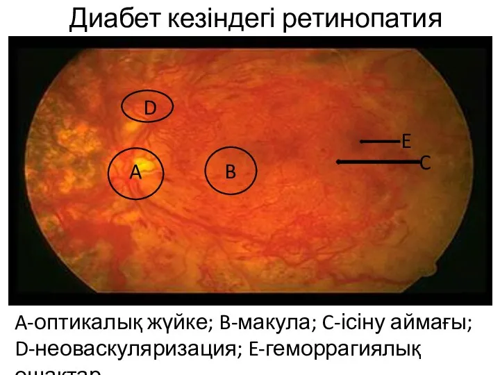 Диабет кезіндегі ретинопатия A-оптикалық жүйке; B-макула; C-ісіну аймағы; D-неоваскуляризация; E-геморрагиялық ошақтар A B C D E