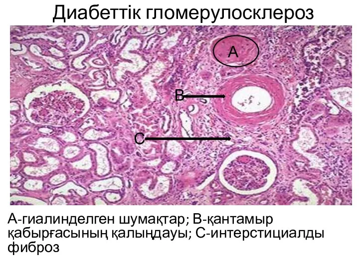 Диабеттік гломерулосклероз А-гиалинделген шумақтар; В-қантамыр қабырғасының қалыңдауы; С-интерстициалды фиброз А В С