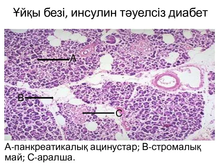 Ұйқы безі, инсулин тәуелсіз диабет А-панкреатикалық ацинустар; В-стромалық май; С-аралша. А В С