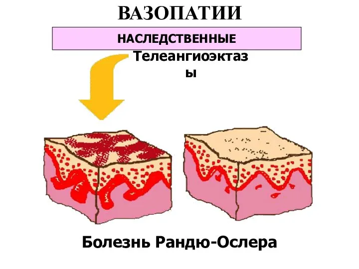 ВАЗОПАТИИ НАСЛЕДСТВЕННЫЕ Болезнь Рандю-Ослера Телеангиоэктазы