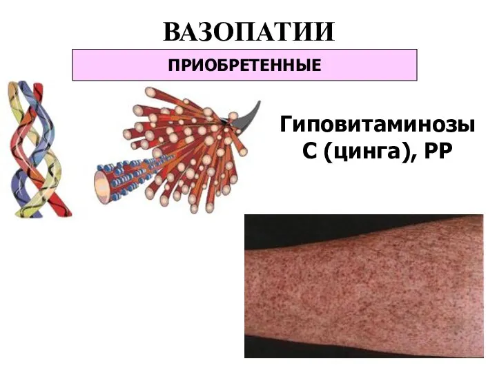 ВАЗОПАТИИ ПРИОБРЕТЕННЫЕ Гиповитаминозы С (цинга), РР