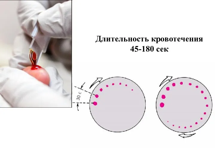 Длительность кровотечения 45-180 сек