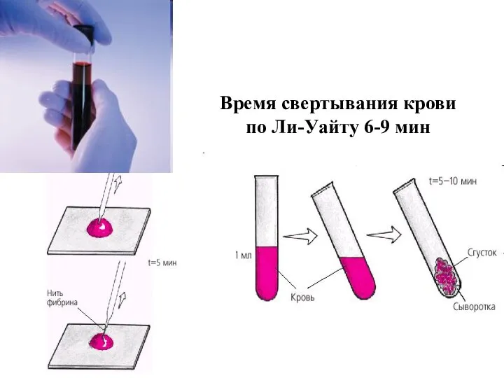 Время свертывания крови по Ли-Уайту 6-9 мин