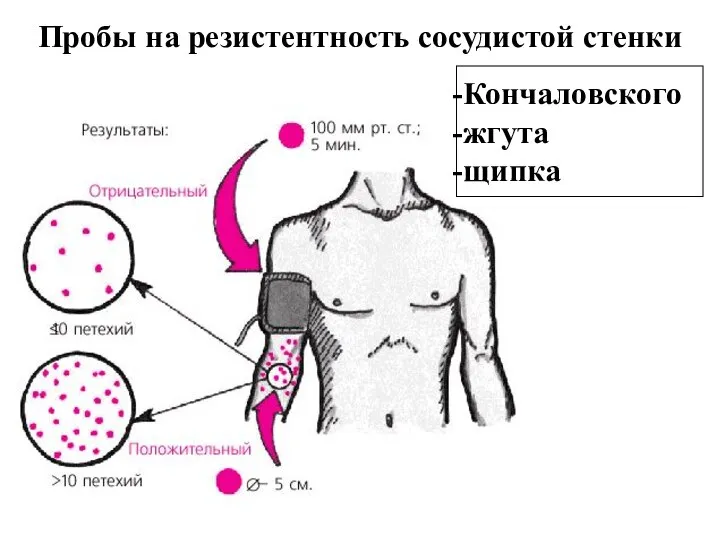 Пробы на резистентность сосудистой стенки Кончаловского жгута щипка