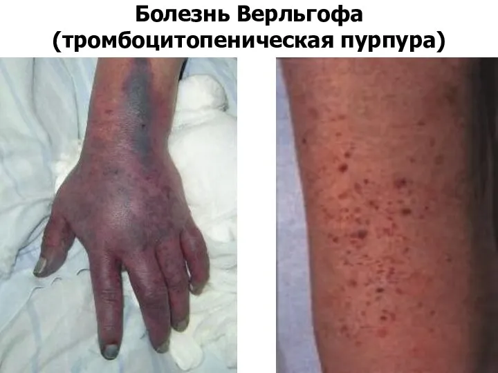 Болезнь Верльгофа (тромбоцитопеническая пурпура)