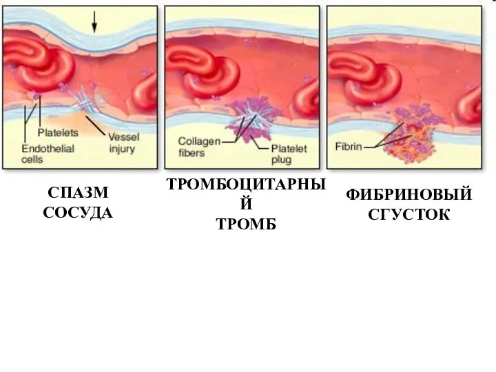 СПАЗМ СОСУДА ТРОМБОЦИТАРНЫЙ ТРОМБ ФИБРИНОВЫЙ СГУСТОК