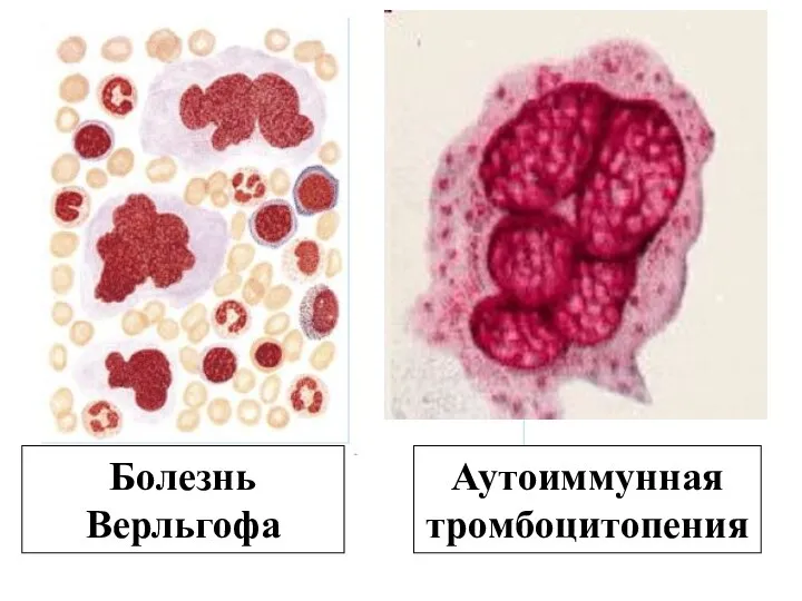 Болезнь Верльгофа Аутоиммунная тромбоцитопения