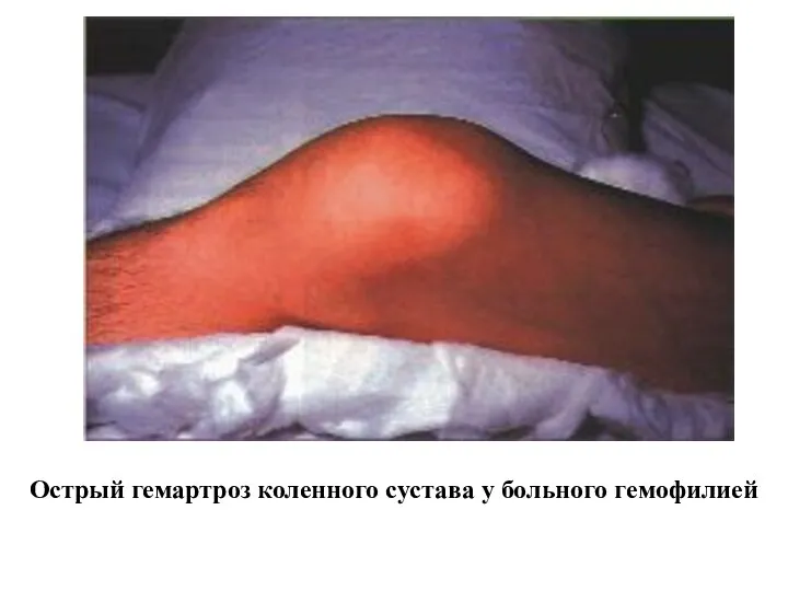 Острый гемартроз коленного сустава у больного гемофилией