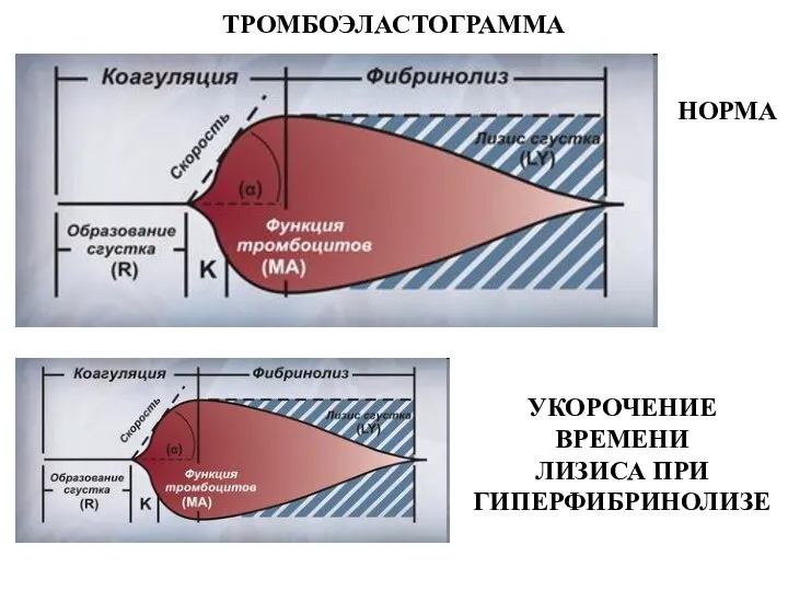 ТРОМБОЭЛАСТОГРАММА НОРМА УКОРОЧЕНИЕ ВРЕМЕНИ ЛИЗИСА ПРИ ГИПЕРФИБРИНОЛИЗЕ