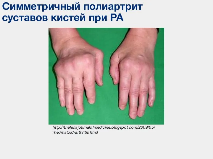 Симметричный полиартрит суставов кистей при РА http://theferiajournalofmedicine.blogspot.com/2009/05/rheumatoid-arthritis.html